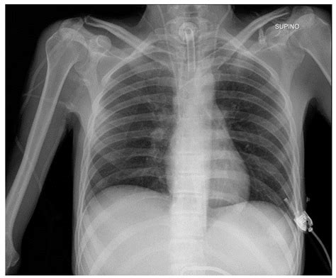 How a Chest X.